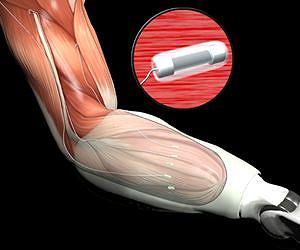 New Nerve and Muscle Interfaces Aid Wounded Warrior Amputees