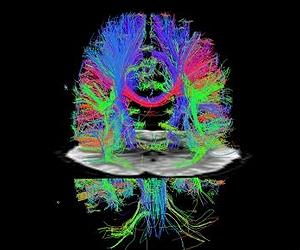 Brain imaging study: A step toward true dream reading
