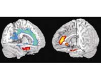 Aggression-Related Gene Weakens Brains Impulse Control Circuits