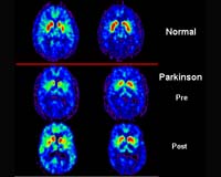Protein Helps Brain 'Clean House'