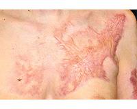 Use of pulsed electric fields may reduce scar formation after burns, other injuries
