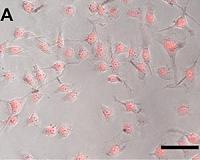 Chemotherapeutic coatings enhance tumor-frying nanoparticles