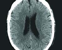 Mars mission Risk 29: Radiation-Induced Brain Damage
