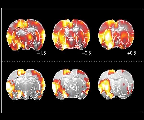 AI-powered technology sees big improvements in UK stroke treatment: analysis