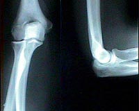 Laser Processes Promise Better Artificial Joints, Arterial Stents