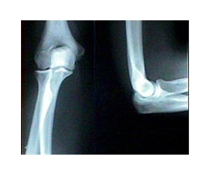 Biological Joints Could Replace Artificial Joints Soon