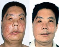 China face transplant patient dead: doctor