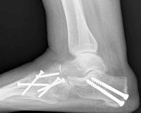 Nano-shells deliver molecules that tell bone to repair itself