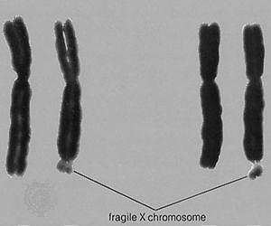 Most common form of inherited intellectual disability may be treatable