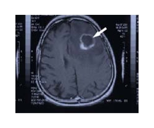 Treatment of common virus can reduce tumour growth