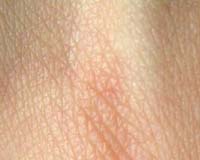 Scientists Produce Neurons From Human Skin
