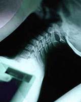 One Small Step Means Giant Leap For Spinal Cord Research