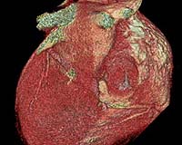Patients get heart valve without surgery