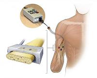 Restoring the sense of touch in amputees using natural signals of the nervous system