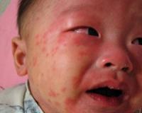China winds could carry childhood disease to Japan: study