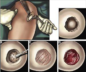 Tissue Engineers Report Knee Cartilage Repair Success With New Biomaterial