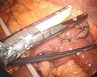 Robot Surgery Successful In Gastric Bypass