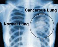 Gene found to protect against lung cancer