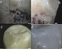 Analysis of Neanderthal teeth grooves uncovers evidence of prehistoric dentistry