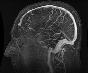 Measuring skull pressure without the headache