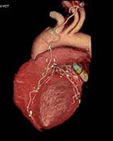 NASA Teams with MetroHealth To Detect Cardiac Arrhythmias In Astronauts