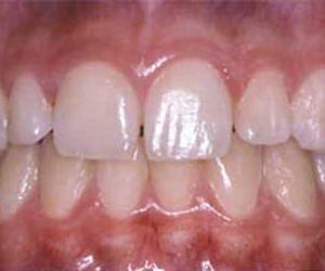 Biological tooth replacement getting closer
