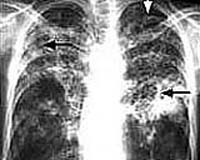 Africa Braces For New, Deadly, TB Strains