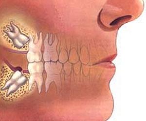 A Smarter Use For Wisdom Teeth - Stem Cells