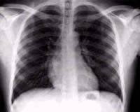 New Kodak X-Ray Imaging Film To Cut Radiation Dose By Half